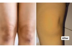 Trik memutihkan lutut gelap pakai 1 jenis rempah dapur, kulit cerah merata tanpa produk bleaching