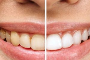 Tanpa jeruk nipis dan garam, ini trik atasi noda kuning di permukaan gigi pakai 1 jenis buah-buahan