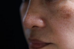 Tak perlu suntik putih, ini trik hilangkan noda hitam di kulit kusam pakai 1 sumber karbohidrat