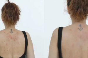 Tak perlu krim dokter, ini trik simpel hilangkan jerawat di punggung pakai 1 bahan masakan