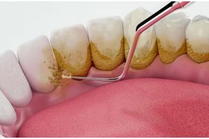 Bukan pakai kunyit, ini trik lunturkan noda kuning agar gigi kinclong pakai 1 jenis buah