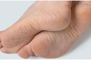 Tanpa tambahan baking soda, ini cara menghaluskan telapak kaki kasar auto mulus pakai 1 pembersih gigi