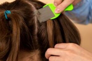 Tak cuma pakai lemon, ini cara menghilangkan kutu penyebab kepala gatal dengan tambahan 1 bumbu dapur