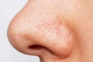 Tanpa scrub kopi dan kunyit, ini trik hilangkan komedo hitam pada hidung pakai 1 jenis daun penyedap