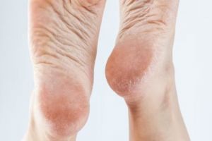 Tanpa garam dan jeruk nipis, ini trik bikin tumit pecah-pecah jadi halus pakai 1 jenis bahan pemanis