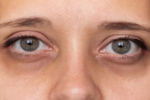 Nggak cuma pakai kopi, ini trik cerahkan kantung mata hitam dengan tambahan 1 jenis umbi-umbian