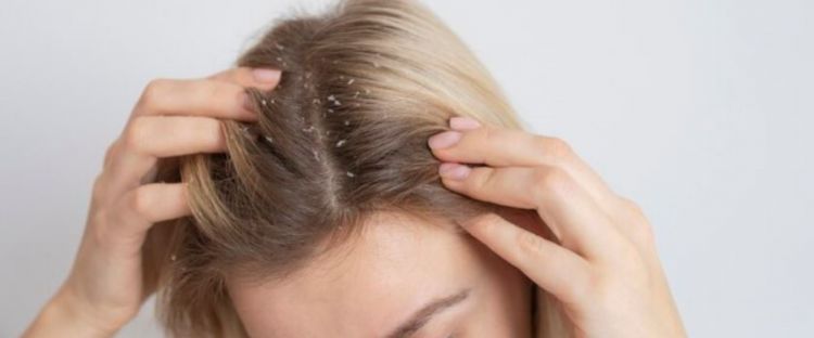 Nggak hanya pakai minyak zaitun, begini cara hilangkan ketombe kering dengan tambahan 1 bahan minuman