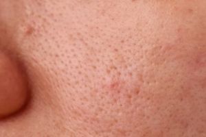 Tanpa teh hijau, ini cara atasi minyak berlebih di wajah penyebab pori besar pakai 2 jenis buah-buahan