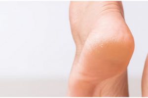 Tak pakai lemon, ini cara rontokan kulit mati penyebab tumit kaki retak dengan 1 bahan pemanis