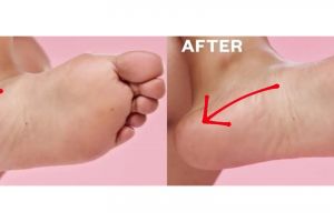 Bukan dengan lilin, ini trik bikin tumit kasar jadi mulus bebas pecah-pecah pakai 2 jenis buah