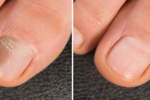 Tak perlu manicure di salon, ini trik atasi kuku kuning berjamur pakai 1 bahan pemanis