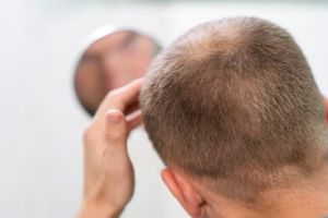 Tanpa produk hair serum, ini trik tumbuhkan kembali rambut di area kepala pitak pakai 1 jenis rempah