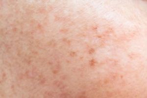 Tanpa tambahan air lemon, ini trik pudarkan flek hitam dan jerawat di wajah pakai 1 jenis olahan susu