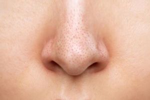 Tak perlu beli pore pack, ini trik bersihkan komedo hitam area hidung pakai 1 bahan dapur