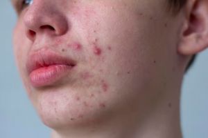 Tanpa toner AHA BHA, ini trik bersihkan wajah dari jerawat dan bekasnya pakai 1 jenis sayur