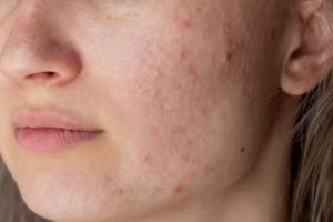 Nggak perlu acne patch, begini cara mengurangi peradangan jerawat saat breakout pakai 1 jenis buah