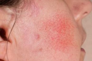 Tanpa tambahan aloe vera, ini cara merawat wajah sensitif agar tak iritasi pakai 2 jenis bahan pemanis