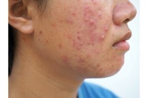 Bukan dioles obat totol, ini trik kempeskan jerawat sebelum meradang pakai 1 jenis daun