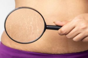 Tak perlu pakai salep, ini cara pudarkan stretch mark setelah melahirkan dengan 1 jenis bahan minuman