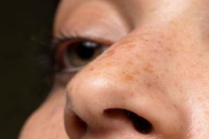 Bukan perawatan laser, ini trik pudarkan flek hitam agar wajah cerah merata pakai 1 jenis rempah