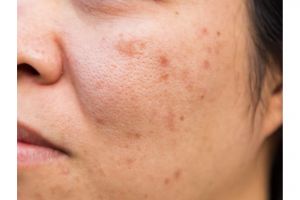 Tak perlu peeling klinik, ini trik hilangkan flek hitam di wajah pakai 1 produk olahan susu