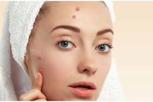 Tanpa beli acne patch, ini trik mengempeskan jerawat meradang hanya pakai masker dari 1 jenis tepung