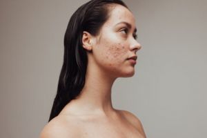 Bukan dioles kunyit, ini trik hilangkan jerawat dan bekas sampai ke akar pakai 1 jenis buah