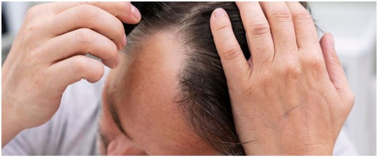 Tanpa gunakan minyak kemiri, ini cara menumbuhkan rambut botak pakai 1 ekstrak bunga