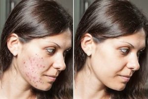 Tanpa pakai skincare mahal, ini cara menghilangkan noda hitam membandel di wajah pakai 2 jenis daun