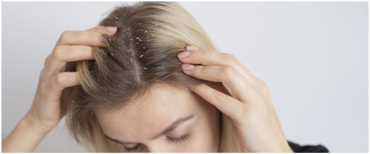 Kulit kepala antigatal, ini cara optimalkan sampo untuk menghilangkan