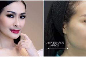 9 Potret Iis Dahlia sesudah jalani perawatan tanam benang, parasnya kian muda di usia 51 tahun