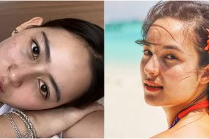 Pesona 9 seleb pamer wajah freckles ini disorot, Prilly disebut cantik natural