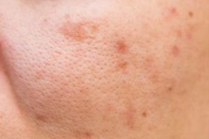 Bebas komedo tanpa putih telur, ini trik bersihkan pori-pori wajah tersumbat pakai 1 bahan kue