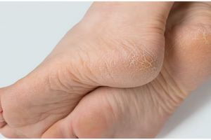 Tanpa direndam air garam, ini trik atasi tumit kaki pecah-pecah pakai 1 alat pembersih gigi