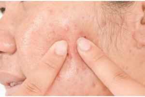 Tanpa campuran lemon, ini trik hempaskan jerawat dan bekasnya pakai masker dari 1 jenis biji-bijian