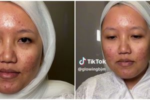 Nggak ada request khusus, pengantin wajah berjerawat di-makeup natural ini cantiknya bak gadis melayu
