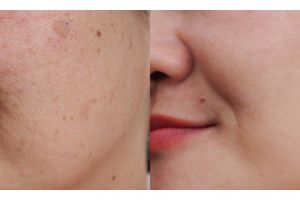 Tak perlu serum pemutih, ini trik enyahkan flek hitam pada kulit kusam pakai 2 jenis tepung