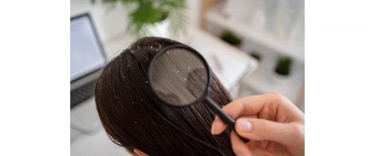 Tak cukup pakai sampo biasa, ini trik hilangkan ketombe di rambut agar tak berkerak pakai 1 jenis buah