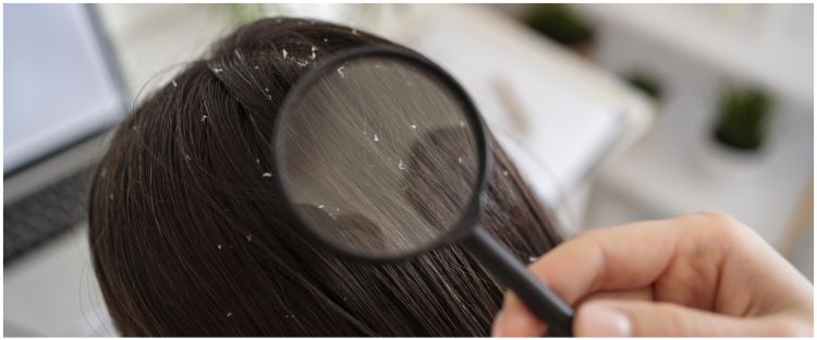 Bebas serpihan putih, ini trik bersihkan rambut penuh ketombe pakai hair mask dari 1 protein