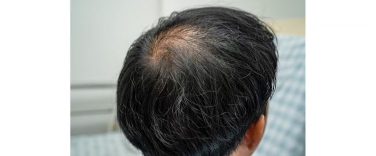 Tak perlu habbatussauda, ini trik atasi rambut rusak dan beruban pakai 1 makanan pokok