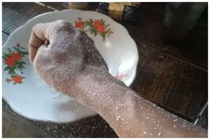 Pakai 1 bumbu dapur, ini cara mengatasi kulit yang tersiram air panas agar tak melepuh dan berbekas