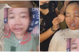Alami kecelakaan H-2 jelang nikah bikin wajah penuh luka, hasil makeup pengantin ini bikin pangling