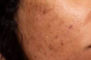 Tanpa pakai kunyit, ini cara menghilangkan flek hitam membandel hanya dengan 1 jenis bahan pemanis