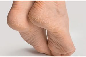 Tanpa gunakan krim wax, ini cara menghaluskan tumit kaki retak dan menghitam pakai 1 jenis minyak