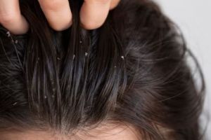 Bersih dari ketombe dan gatal, begini cara atasi kepala berminyak pakai 1 jenis bumbu dapur