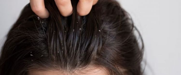 Bersih dari ketombe dan gatal, begini cara atasi kepala berminyak pakai 1 jenis bumbu dapur