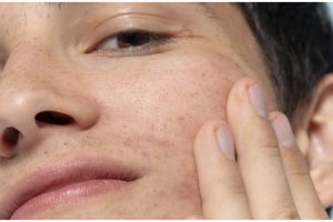 Tanpa gunakan krim pemutih, ini trik atasi pigmentasi pada wajah pakai 1 jenis tepung