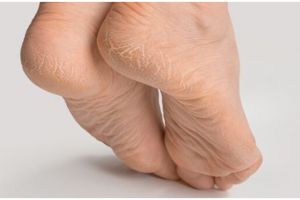 Tanpa gunakan krim wax, ini cara menghaluskan tumit kaki retak dan menghitam pakai 1 jenis buah