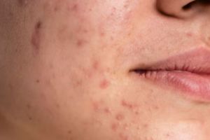 Wajah mulus tanpa laser, ini cara pudarkan flek dan noda hitam pakai masker dari 1 jenis buah