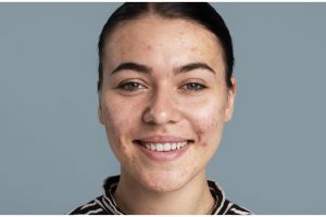 Tak gunakan krim pemutih, ini trik hilangkan flek hitam di wajah pakai krim dari 1 kulit buah